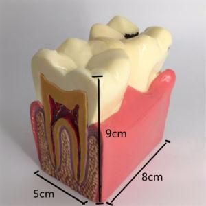 Restoration Tooth and Dental Implant Model Dental Decoration Teach Model