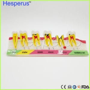 Dental Caries Developing Illusteation Teeth Model