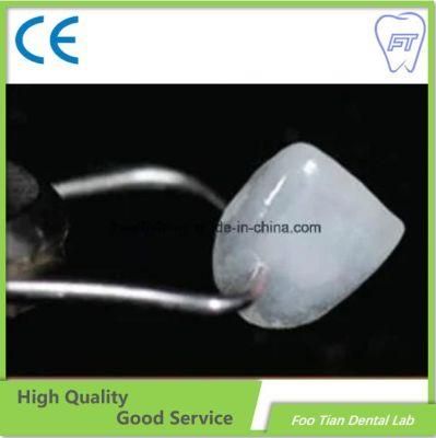 Hot Sale Dental All Ceramic Inlays Onlays Made in China Dental Lab