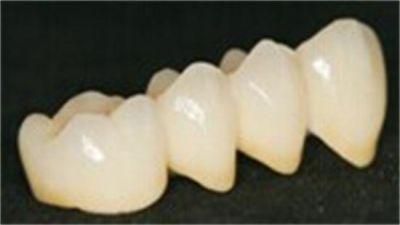 Dental Cement-Retained Implant Crown From China Dental Lab
