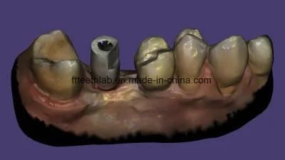 CAD Cam Digital Screwed Metal Ceramic Implant Crown